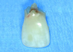 Fig 4. Tooth extracted with internal resorption.