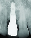 Fig 15. Radiograph of final restoration (implant placed by periodontist David Barack, DDS).