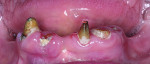 Fig 17. Lower anterior teeth with hopeless prognosis.