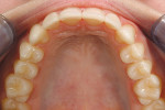 Figure 13  Occlusal view showing coverage ofthe exposed dentin and appropriate arch andembrasure forms.