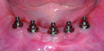 Fig 19. Healed implants with abutments in place showing excellent spacing among the implants (implants placed by oral surgeon Mark J. Steinberg, DDS, MD).