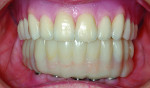 Fig 21. Try-in of the lower provisional against the wax try-in upper denture.