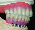 Fig 22. Lateral view of upper final denture opposing final zirconia bridge.