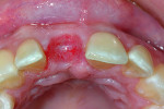 Fig 8. The buccal-palatal width was maintained with a proper grafted site, and ovate pontic created for the provisional.