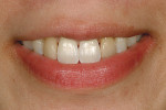 Figure 16  Photograph showing the color discrepancybetween the bleached natural dentitionand the original 11-year-old veneer.