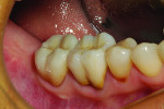 The final restorations in the mouth.