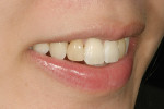Figure 17  Smile view of the right side revealingthe black triangles between the teeth.