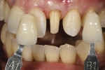 Figure 18  Close-up view of the refined, moreaggressive peg lateral veneer preparation of prioryears, including shade tabs for communication ofcolor to the ceramist.