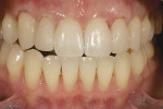 Figure 19  Bis-Acrylic prototype restorationswere used in the mouth to work out the imperfectionsof varying width and length, as well as thefinal arrangement.