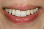 Figure 20  Frontal view of the patient"s smilemakeover.
