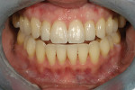 Figure 21  Retracted frontal view showing theelimination of the black triangles and the appropriatetooth arrangement and color for this30-year-old patient.