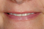 Figure 23  Preoperative view of the smile ofthe patient embarrassed by her teeth.