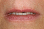 Figure 24  Repose view showing no maxillarytooth exposure and the worn lower dentition.