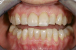 Figure 5  Retracted preoperative view revealingthe fractured veneer on tooth No. 9 and theaged and worn dentition.