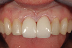 Figure 26  A try-in of veneers on teeth Nos. 8and 9 demonstrates a color discrepancy in chromaand value.