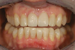Figure 28  Retracted view showing the completeddirect composite veneers on teeth Nos. 6, 7,10, 11, 24, and 25. Restoration prototypes areseen on teeth No. 8 and 9.