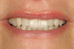 Figure 29  Smile view of the completedrestorations after cementation. Note the completeenhancement of the patient"s smile.