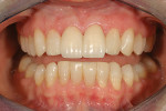 Figure 30  Retracted view of the final restorationsafter cementation. Note the high polish thatwas accomplished.