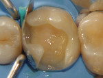 Composi-Tight® Gold Matrix System in place (Garrison Dental Solutions).