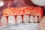 Example of acellular dermal matrix graft (AlloDerm) trimmed and placed on the surface before insertion into the tunnel preparation facial to the first molar through the central  incisor (different patient).