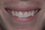 High lip dynamics on maxillary and low
smile line on mandibular—buccal corridor not developed.