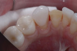 IPS e.max carried to the lingual for resistance form on contralateral canine.