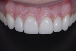 Excellent tooth form, shape, color gradation, and gingival esthetics.