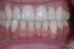 Final result with buccal corridor developed in maximum intercuspation.