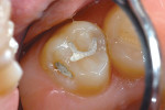 Figure 1   A second molar with a glass-ionomersilver cermet restoration, 17 years after placement.Note that there is little wear or erosion.