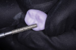 The flat-ended parallel medium-grit diamond
bur is extremely effective for sprue removal, interproximal adjustments, contouring, and enhancing or adding anatomy.