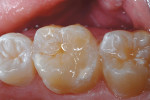Figure 9  The newly restored tooth, immediatelyafter RBC repair.