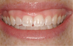 Figure 1  The patient presented with multipleareas of hypocalcification on teeth Nos. 8 and 9.