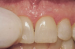 Monolithic full-contour lithium-disilicate crowns on teeth Nos. 8 and 9 in premature contact. Fremitus was noted with digital palpation.
