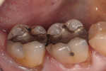 Initial occlusal view of teeth Nos. 30 and 31 at initial presentation. Note several crack lines
and patient was symptomatic with cold sensitivity.