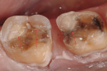 Occlusal view of teeth Nos. 30 and 31 after preparation. Note crack lines present on occlusal surface.