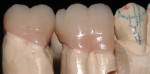 Monolithic, full-contour, lithium-disilicate, full-contour crowns fabricated and polished prior to additional staining and glazing.