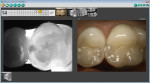 CariVu caries detection device image