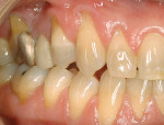 Figure 2  Recession was evident on maxillary teeth Nos. 3 through 8 with significant mucogingival defects on teeth Nos. 3, 5, and 6. Mandibular teeth Nos. 26 through 30 also exhibited recession with mucogingival defects on teeth Nos. 27 and 28.