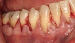 Figure 4  A modified tunnel approach wasused for the mandibular site (from teeth Nos. 24through 30). Alternate papillae were elevated toallow placement of the allograft. Note maintenanceof papilla between teeth Nos. 25 and 26,Nos. 27 and 28, and Nos.