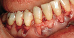 Figure 7  A 1 cm x 4 cm allograft was placed after mandibular teeth root preparation with finishing burs and tetracycline treatment. The graft was secured with 5-0 gut interproximally.