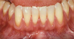 Figure 18  The retracted mandibular buccalview revealing recession, thin biotype, and inadequatebands of keratinized tissue.