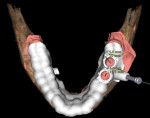 Fig 4. After treatment planning, digital image of surgical guide that will be used at the time of surgery to place implants in the Figure 3 patient case.