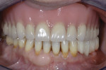Fig 3. New maxillary denture and lower left provisional restoration.
