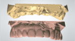 Fig 9. Scan of immediate-load hybrid prosthesis cast and master cast.