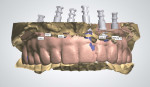 Fig 10. Digital image of three scanned casts
merged.