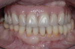 Fig 6. Provisional restoration after palate and labial flanges were removed.