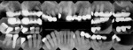 Fig 1. Pretreatment radiographs. Note the advanced caries, periodontal involvement, and periapical radiolucencies.