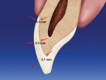 Figure 1  Depiction of enamel thickness on thefacial aspect of the tooth.