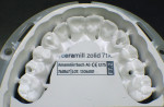 Fig 14. Final digital design nested in a zirconia block and milled.