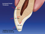 Figure 2  The facial thickness of the tooth isincreased with the additive composite mock-up.